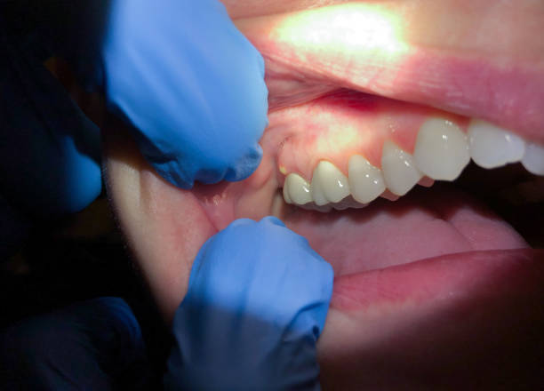 Best Emergency Wisdom Teeth Removal in Pocono Woodland Lakes, PA